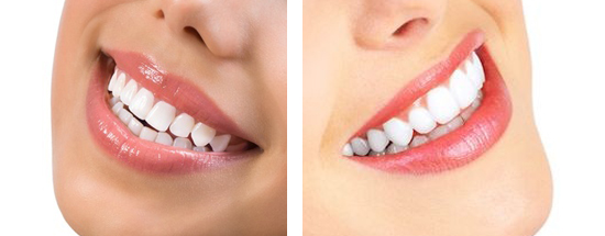 teeth-whitening-v2