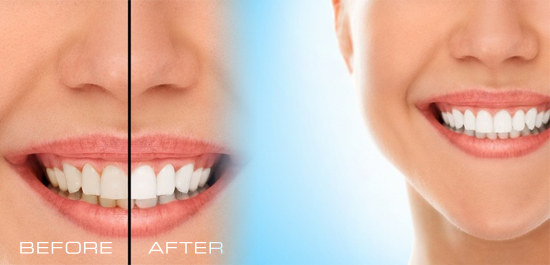 teeth-whitening